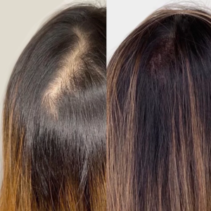 Before | After - 3 | KIK Scalp Micropigmentation Design and Treatment