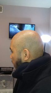 Side profile 1 | KIK Scalp Micropigmentation Design and Treatment