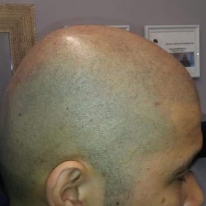 4 | KIK Scalp Micropigmentation Design and Treatment