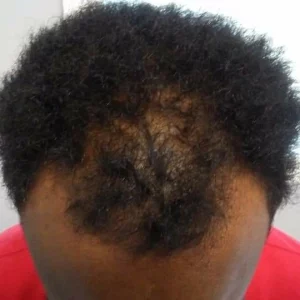 Before 5a | KIK Scalp Micropigmentation Design and Treatment