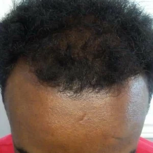 After 5b | KIK Scalp Micropigmentation Design and Treatment