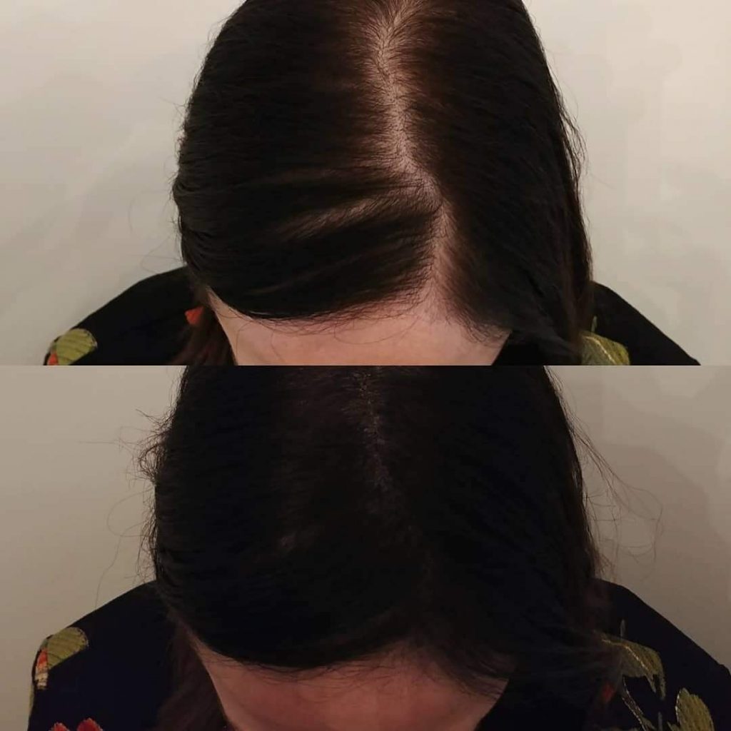 Before | After - 2 | KIK Scalp Micropigmentation Design and Treatment