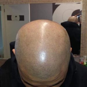 Scalp | KIK Scalp Micropigmentation Design and Treatment