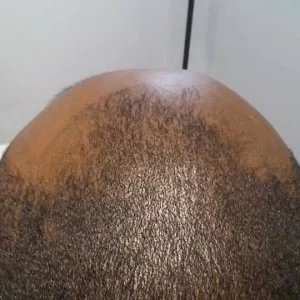 6 | KIK Scalp Micropigmentation Design and Treatment
