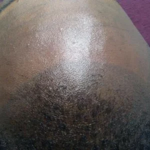 7 | KIK Scalp Micropigmentation Design and Treatment