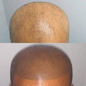 Before | After - 1 | KIK Scalp Micropigmentation Design and Treatment
