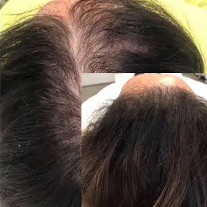 Woman 3 | KIK Scalp Micropigmentation Design and Treatment