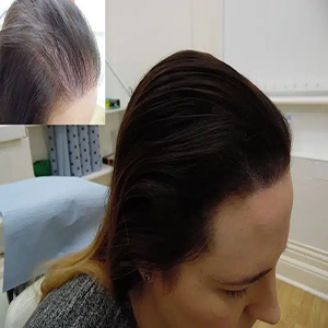 Woman 2 | KIK Scalp Micropigmentation Design and Treatment