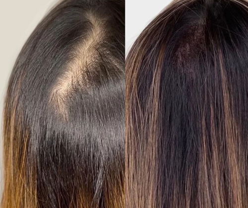 woman_before_after_3 Before | After - 3 | KIK Scalp Micropigmentation Design and Treatment